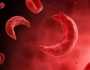فقر الدم المنجلي.. أسباب الإصابة وطرق الوقاية والاعراض