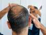علاج جديد لتساقط الشعر يثير ضجة