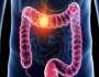 اختراق هام يعطي الأمل لعلاج سرطان الأمعاء