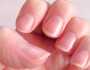 احذر ظهور هذا اللون على الأظافر.. يشير لإصابتك بأمراض خطيرة