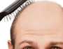 حلول فعالة لاستعادة شعرك.. أفضل الطرق لمواجهة الصلع الوراثي لدى الرجال