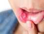 6 نصائح للتعامل مع قرح الفم.. بينها «التوقف عن التدخين»