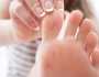 5 علامات في القدم تدل على الإصابة بسرطان الجلد.. توجه للطبيب فورا