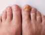 7 علامات تظهر في القدمين تدل على الإصابة بـ تليف الكبد