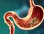 تعرف على أسباب جرثومة المعدة وكيفية القضاء عليها
