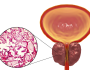 نهج مبتكر لإبطاء سرطان البروستات وتقويض انتشاره