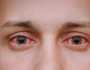 ما سبب جفاف العين في الشتاء؟.. 5 خطوات عملية تعيد الرونق لعينيك
