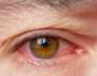 ما مرض التراخوما؟.. التهاب بكتيري في العين يهدد الملايين بالعمى
