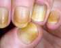 أظافرك الصفراء مؤشر لمرض خطير.. اذهب للطبيب عند ظهور هذه الأعراض