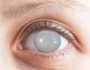 أعراض الماء الأبيض على العين وطرق علاجه