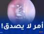 عنكبوت ينسج شبكة داخل أذن إمرأة!