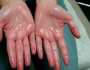 طرق لتفادى مشكلة تعرق اليدين صحة وطب