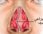 تعرف على الحاجز الأنفي وأعراضة وأسبابة وطرق علاجه