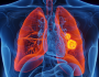 ترقب لتغيير جذري في علاج سرطان الرئة