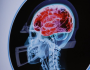 دراسة تربط إصابات الرأس بالزهايمر.. الارتجاج يوقظ الفيروسات النائمة