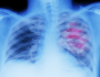علامات لسرطان الرئة يمكن رؤيتها على الوجه!