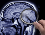 اكتشاف هام قد يحمل مفتاح القضاء على مرض ألزهايمر