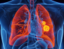 إنجاز هام قد يُحدث تغييرا جذريا في علاج سرطان الرئة