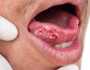 لا تتجاهلها.. أعراض يشير ظهورها إلى الإصابة بسرطان الفم