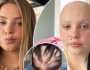 شابة بريطانية تفقد شعرها بالكامل بعد إصابتها بكوفيد 19 لثماني مرات